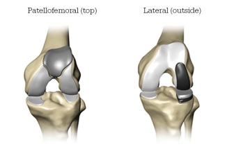 partial knee replacement graphic
