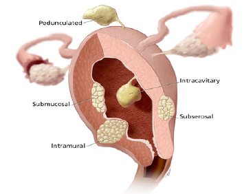 Myomectomy Diagram