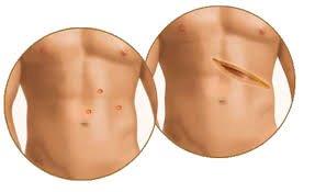 kidney cancer surgery