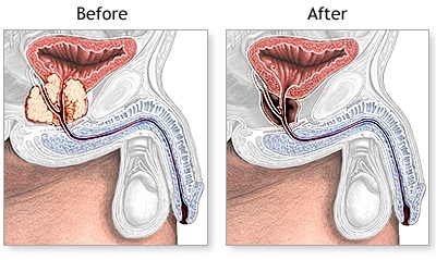 prostate gland surgery time medicamente pentru prostatita din india