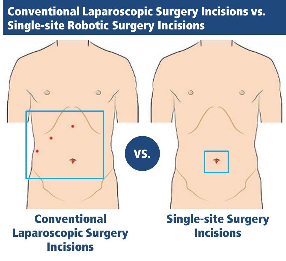 abdominal surgical incisions