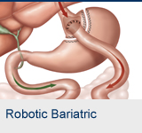 Robotic Bariatric Surgery