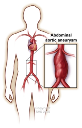 abdominal aortic aneurysm