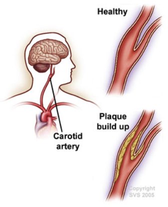 carotid artery blockage